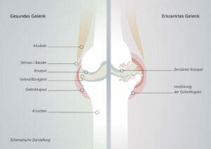 Gesundes Gelenk vs. Krankes Gelenk